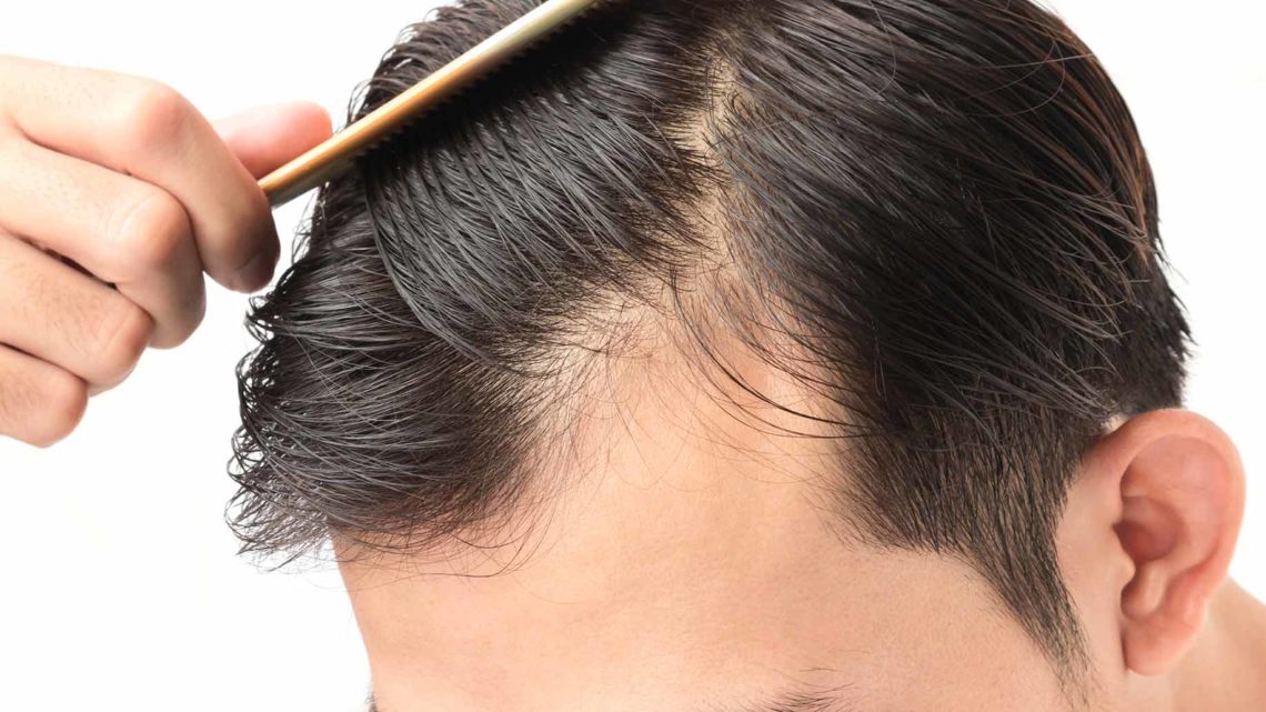 Tips to cope up with hair loss