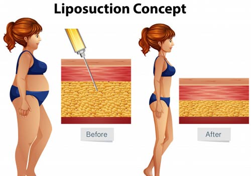 5 Top Exercises for Liposuction Effects