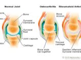 What causes inflammation in the joints?