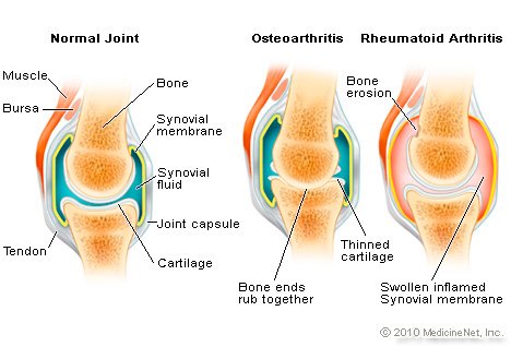 What causes inflammation in the joints?