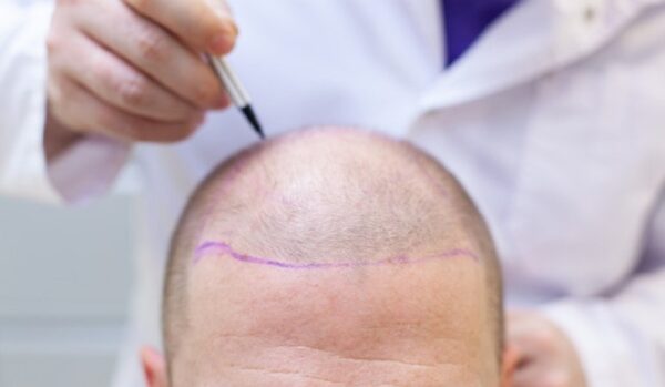 How To Care For Your Hair Post-Hair Transplant Surgery?